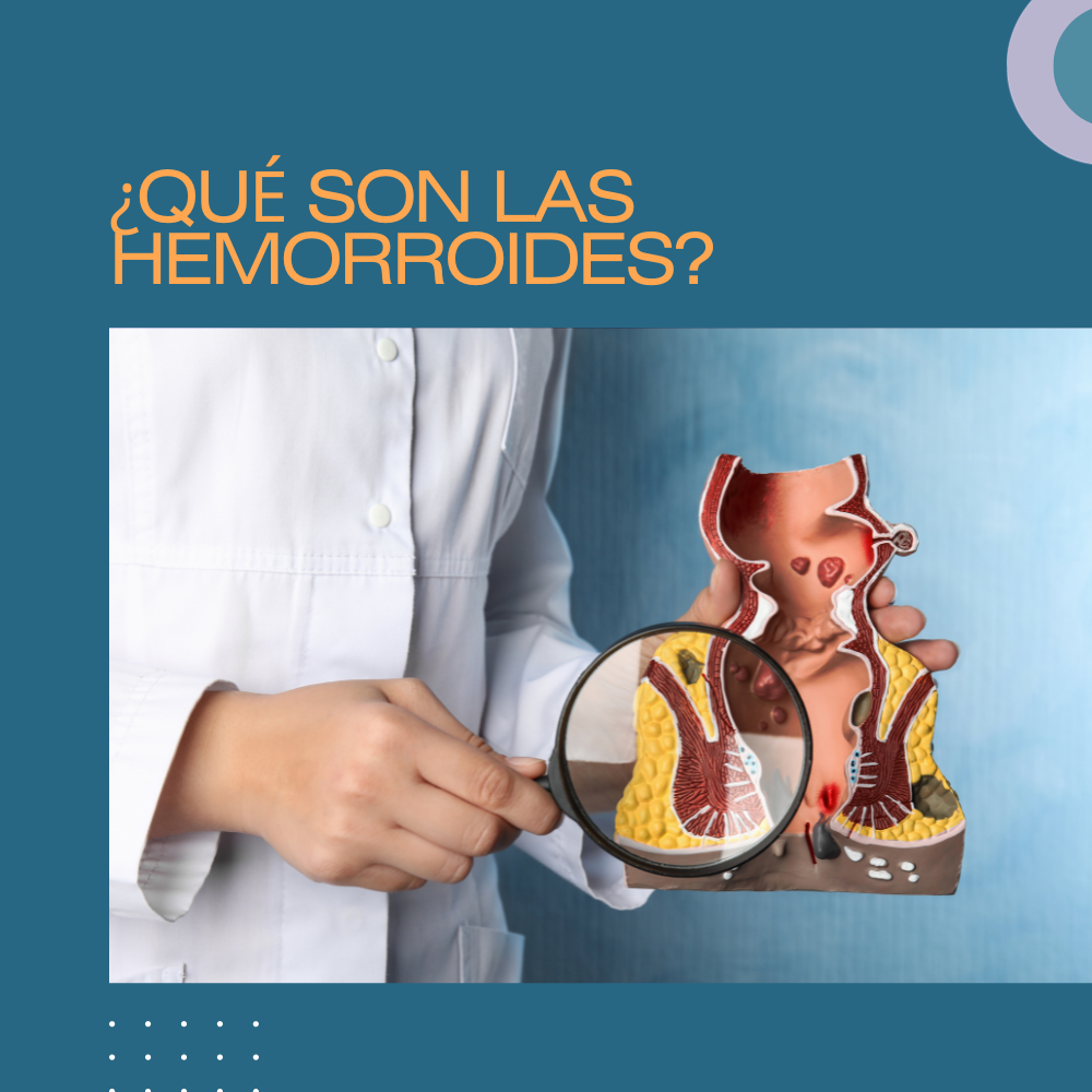 ¿Qué son las hemorroides?