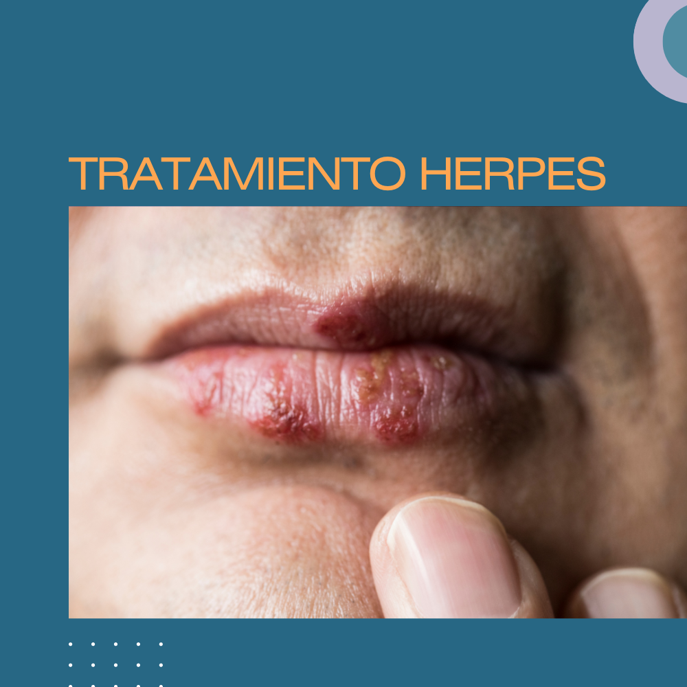 TRATAMIENTO DEL HERPES