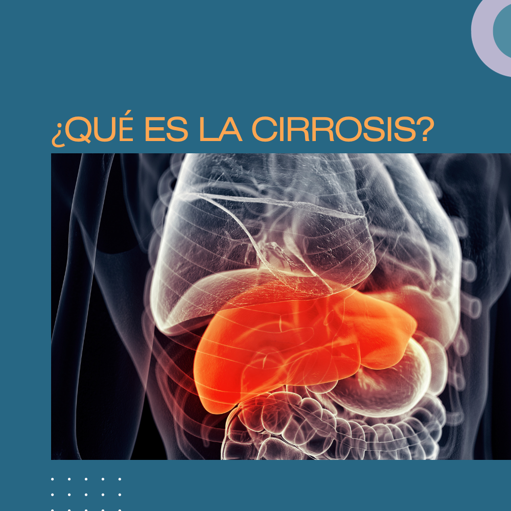 ¿Qué es la cirrosis?