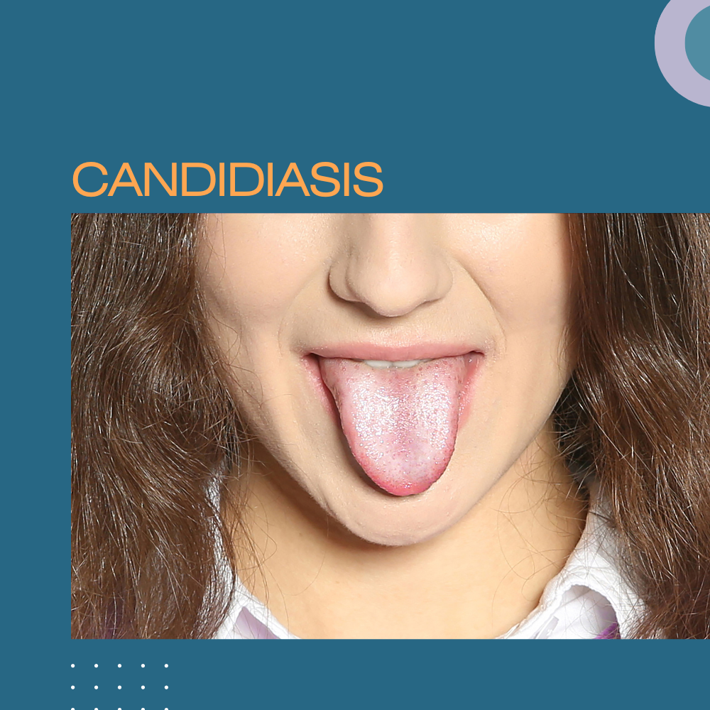 CANDIDIASIS PRESENTACIÓN PPTX