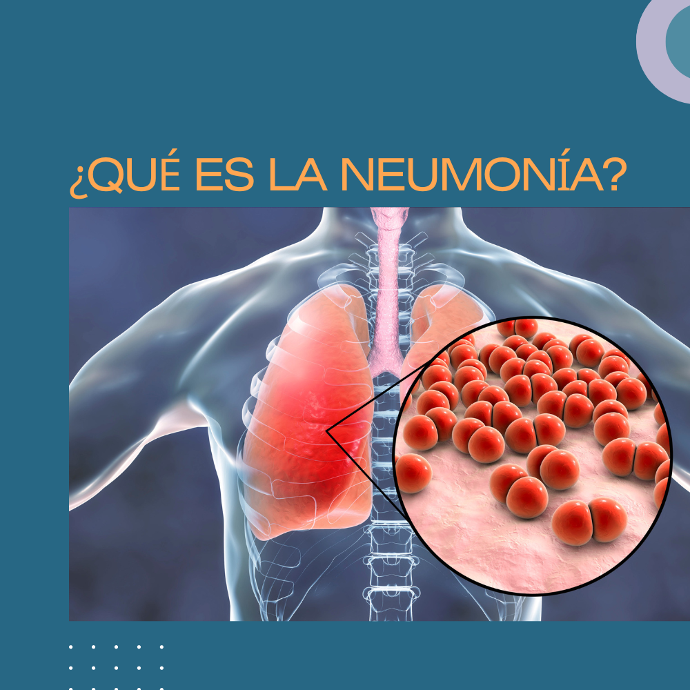 ¿QUÉ ES LA NEUMONÍA?