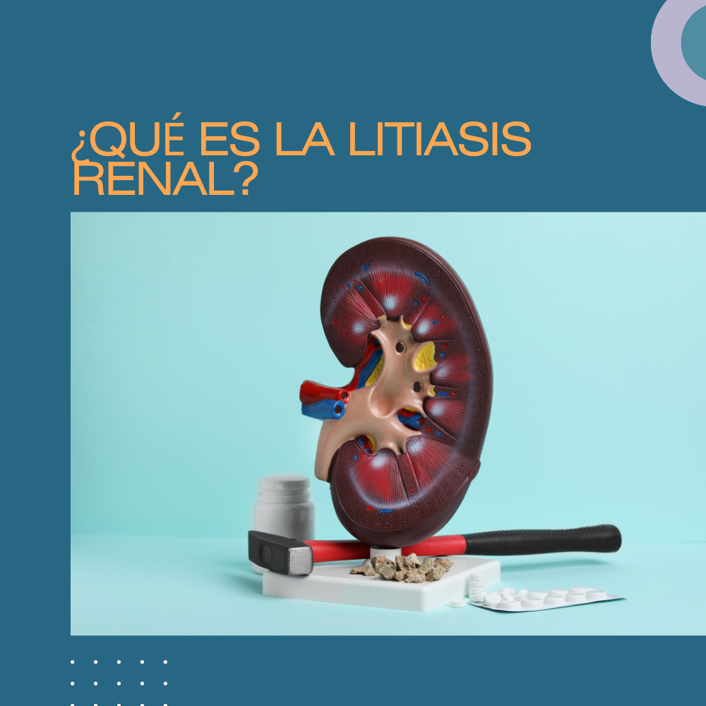 ¿QUÉ ES LA LITIASIS RENAL?