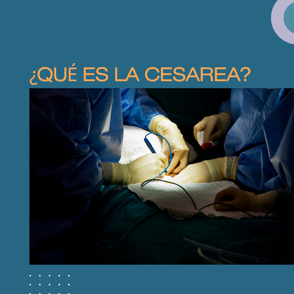 ¿QUÉ ES LA CESAREA?