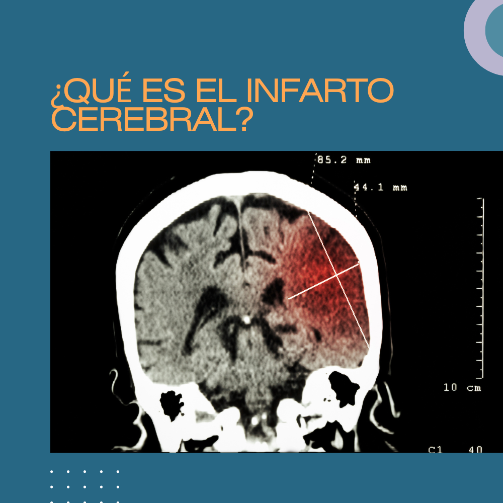 ¿Qué es el infarto cerebral?