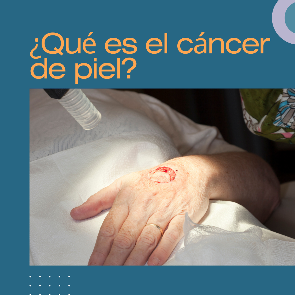 ¿Qué es el cáncer de piel?