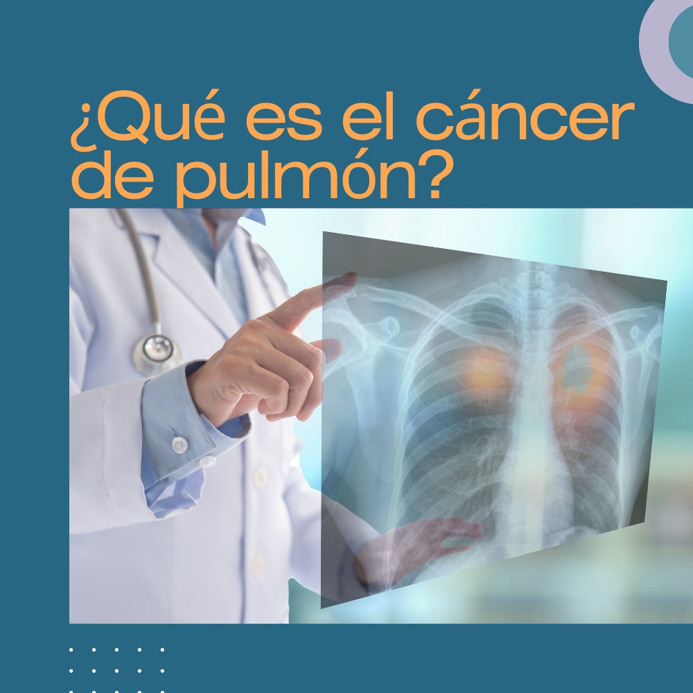 ¿Qué es el cáncer de pulmón?